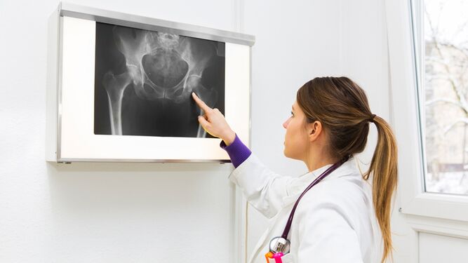 El tratamiento con ácido alendrónico reduce el riesgo de fracturas en la cadera debidas a la osteoporosis