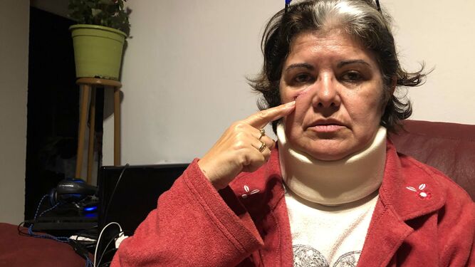 Paqui Gómez, la mujer agredida, muestra una de las heridas en la cara.