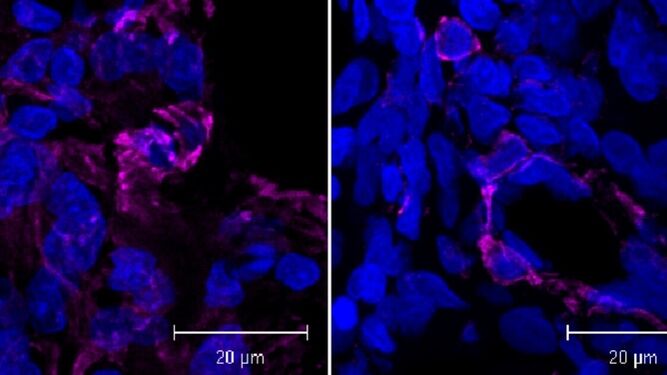 A la izquierda, células pulmonares tratadas con bleomicina con marcadores de fibrosis en rosa. A la derecha, la inoculación de nanopartículas con GSE4 produce una reducción significativa de la fibrosis.