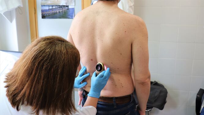 Crece el número de casos de melanomas casi un 50% en los últimos diez años